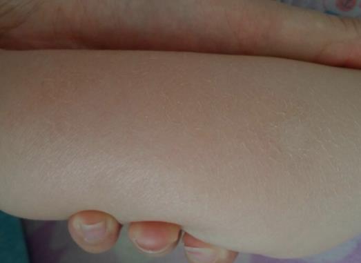 孩子的皮肤出现起皮的问题怎么缓解？宝宝皮肤干燥起皮怎么办？