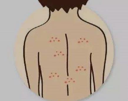女生背部长痘的原因 后背长痘痘是什么原因