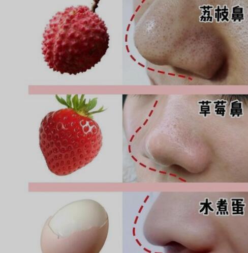 有草莓鼻怎么办？解决草莓鼻的6个小妙招